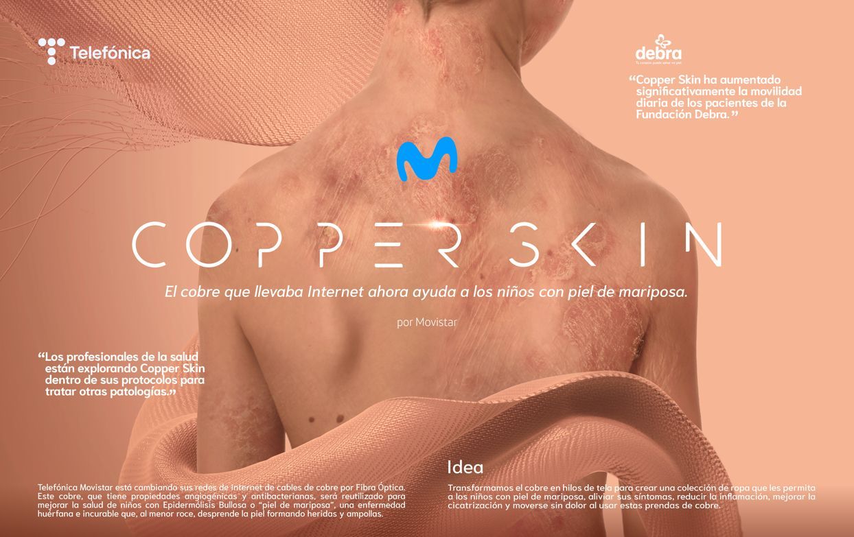 ‘Cooper skin’, iniciativa de Movistar para llevar alivio a los menores con piel mariposa